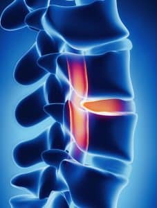 A disc compressing on the spinal cord within the spine. 
