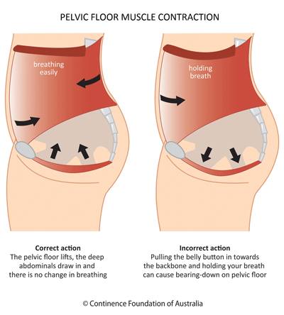 when lifting a weight, the muscles of the ‘core’ work together well- the pelvic floor muscles lift, the abdominal and back muscles draw in to support the spine, and breathing is easy (Diagram 1). In this scenario, the pelvic floor muscles respond appropriately to the increase in abdominal pressure.

If any of the muscles of the ‘core’, including the pelvic floor, are weakened or damaged, this coordinated automatic action may be altered.  In this situation, during exercises that increase the internal abdominal pressure, there is potential to overload the pelvic floor causing depression (Diagram 2). 