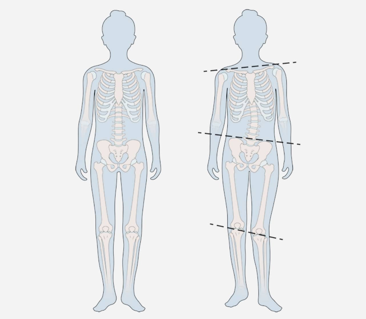 misalignments through the body