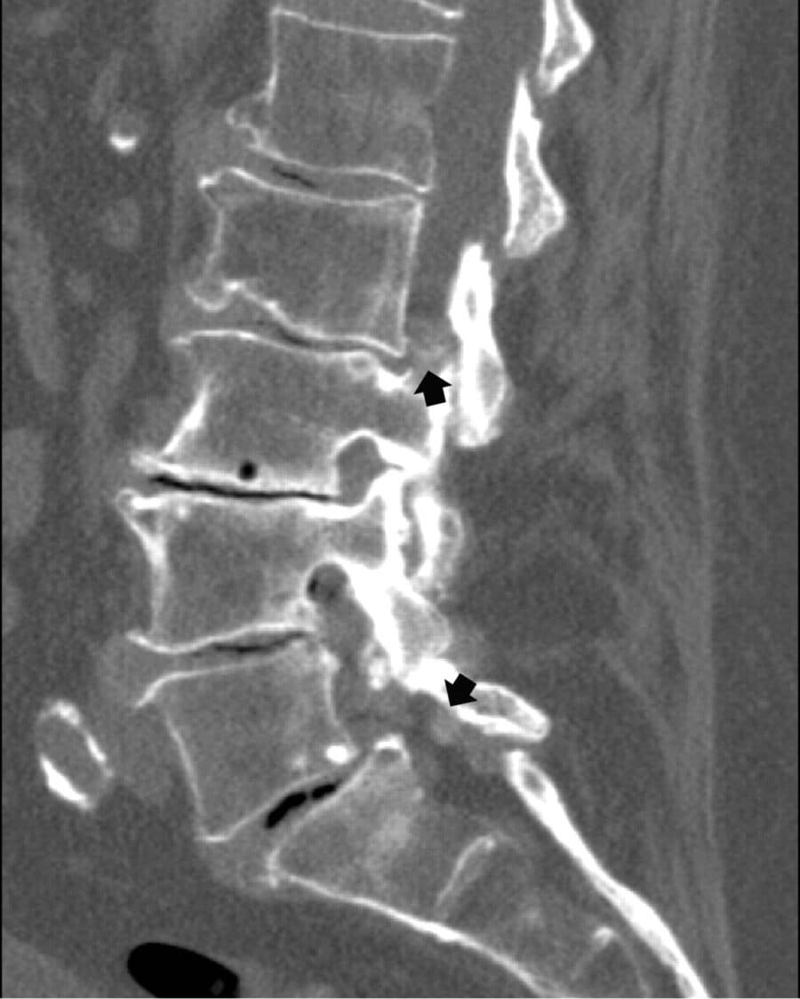 Is Lumbar Spondylosis Serious?