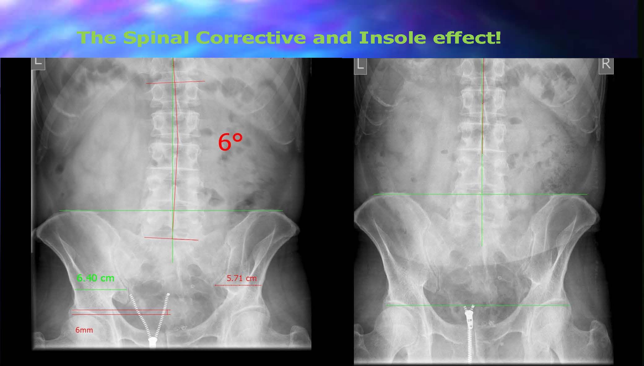 a shorter limb can cause one side of the pelvis to drop or rotate, leading to a tilted pelvic posture visible on an X-ray